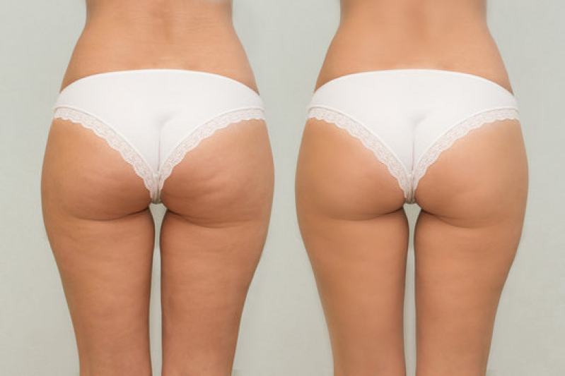 Gluteoplastias