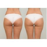 clínica especializada em gluteoplastia de aumento Jardim Consórcio