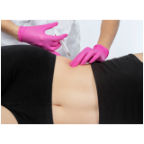 clínica que faz lipo enzimática abdominal Jardim Ernestina