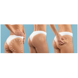 gluteoplastia com bioestimulador marcar Vila Congonhas