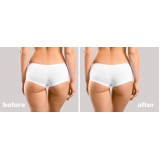 gluteoplastia com harmonização Jardim Prudência