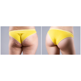 gluteoplastia de aumento marcar Água Rasa