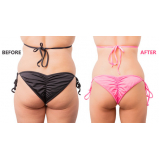 gluteoplastia em homens Jardim Leonor