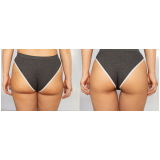 gluteoplastia sem silicone Jardim Ampliação