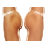 Gluteoplastia com Bioestimulador