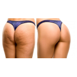 Gluteoplastia de Aumento