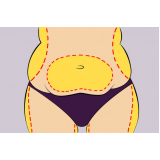 lipo enzimática abdominal Cidade Monções