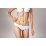 lipo enzimática hd marcar Vila Alexandria