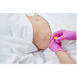 lipo hd enzimas marcar Vila Alexandria