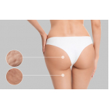 onde marcar gluteoplastia masculina Zona Leste