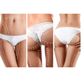 onde marcar gluteoplastia sem silicone Jardim Climax