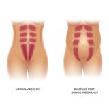 tratamento de diástase abdominal agendar Chácara Santo Antônio