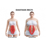 tratamento para diástase abdominal pós parto Jardim Têxtil